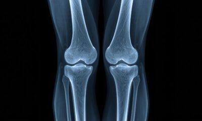 normal knee X-ray